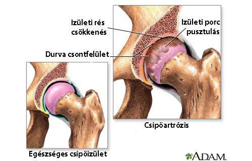 2 3 csípőízület artrózisa fájdalom és repedés a térdízületben