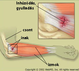 könyök belső oldalán fájdalom