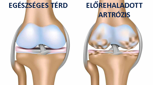 térdízület deformáló artrózis