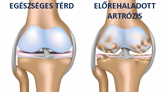 a térd artrózisáig
